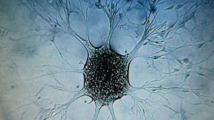 Una nuova terapia con anticorpi per rallentare il glioblastoma