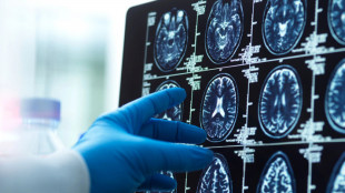 In Gb prima operazione per rimuovere tumore al cervello con l'aiuto dell'IA